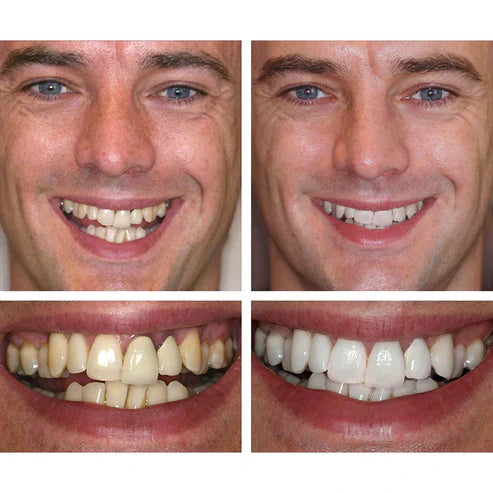 LANTHOME™ Teeth Whitening Essence