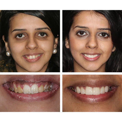 LANTHOME™ Teeth Whitening Essence